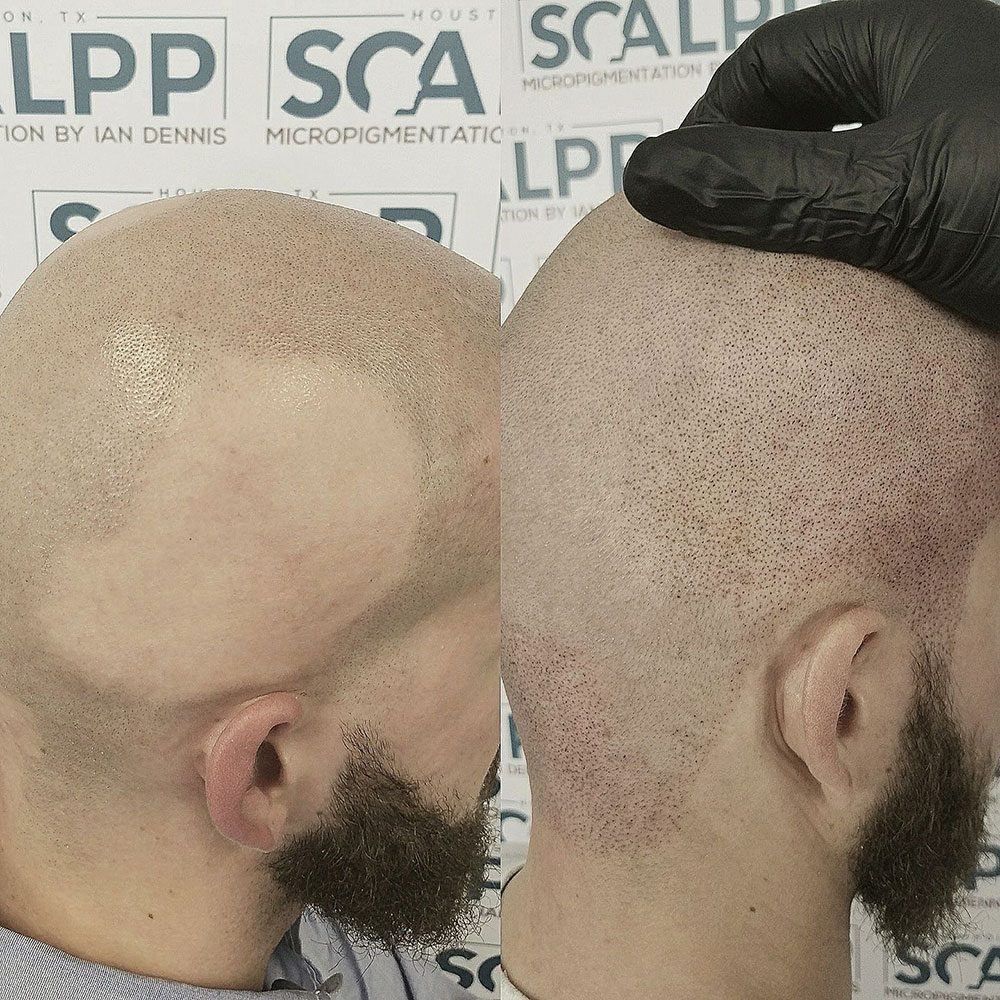 Before and after treatment at our Houston alopecia clinic