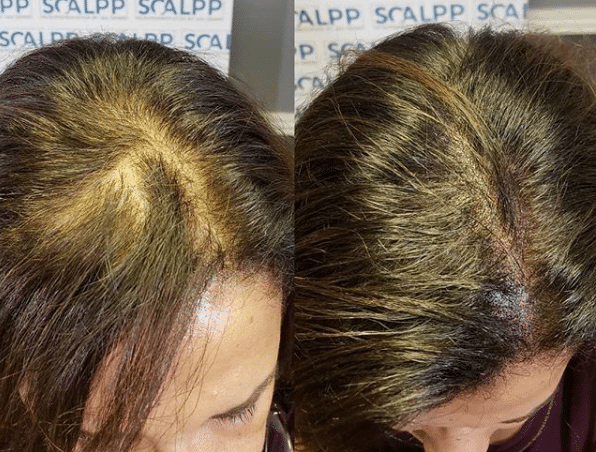 Scalp Micropigmentation For Women Thinning Hair Houston Texas Austin Texas