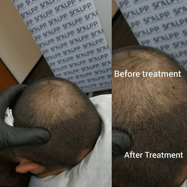 scalp micropigmentation female women hair loss