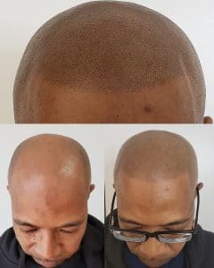 Scalp Micropigmentation In San Antonio 1 Hair Loss Solution Scalpp Clinic