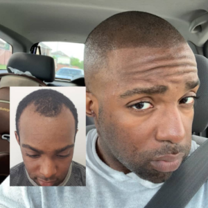 Scalp Micropigmentation In Austin 1 Hair Loss Solution Scalpp Clinic