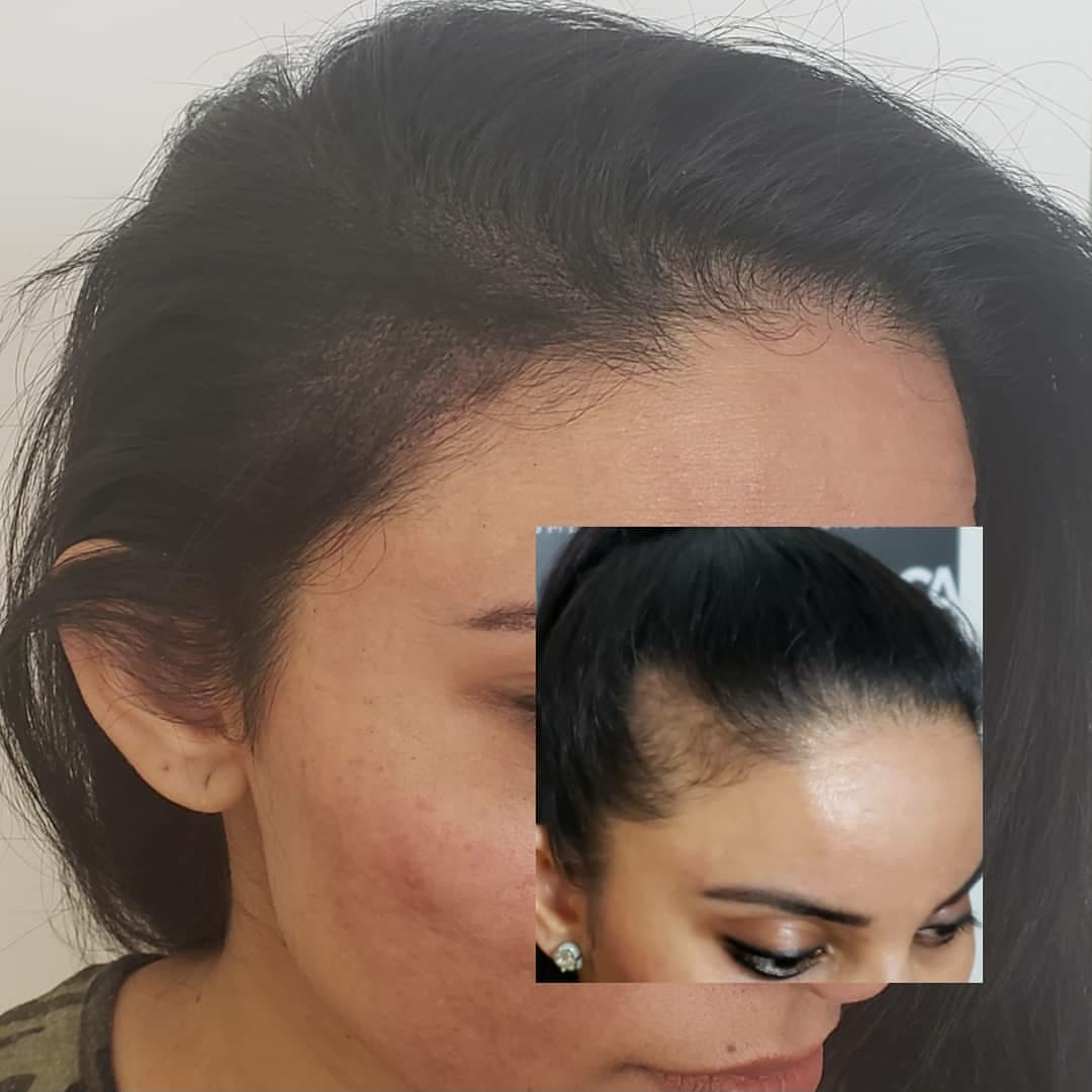 Scalpp Clinic : Scalp Micropigmentation San Antonio (smp)
