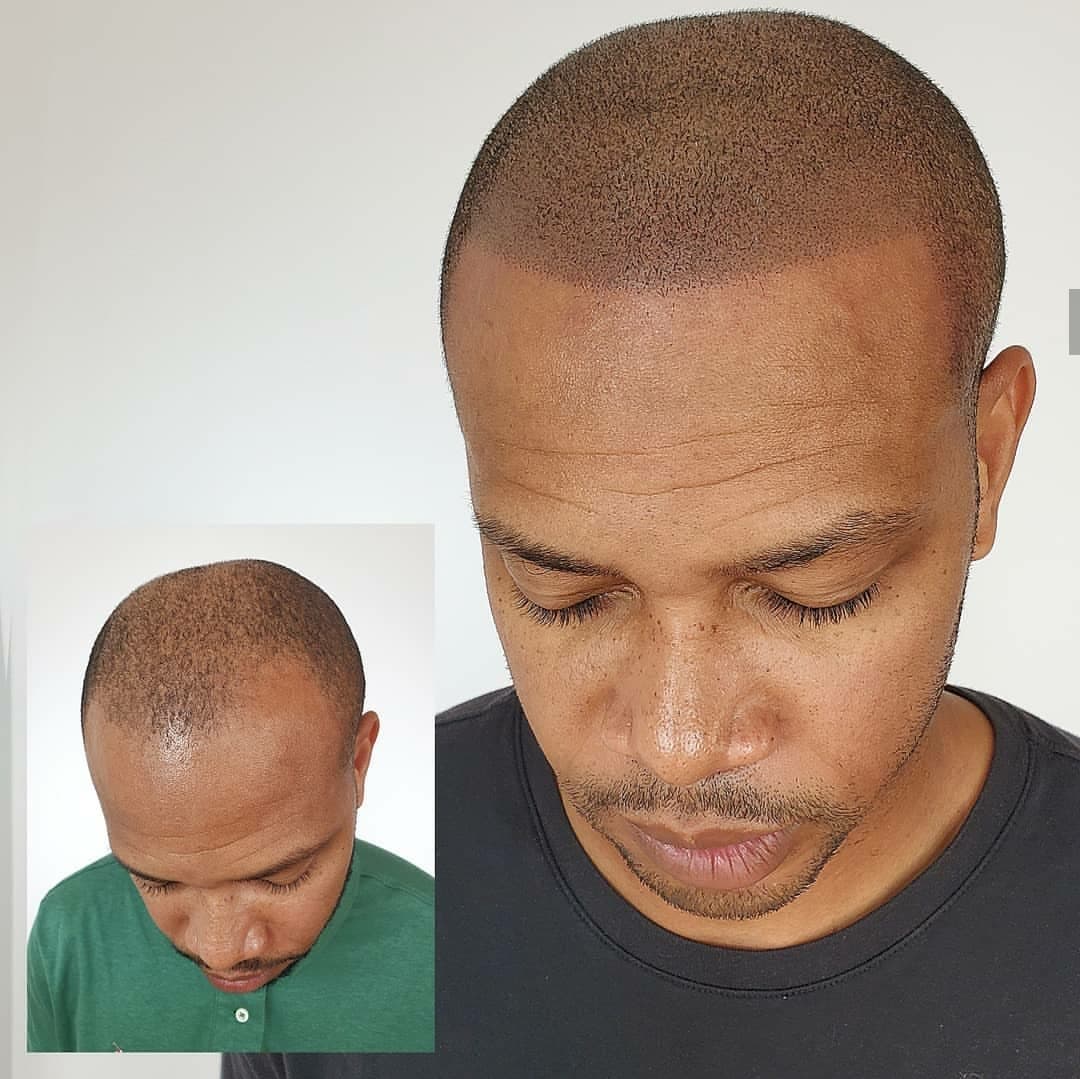 Scalpp Clinic : Scalp Micropigmentation San Antonio (smp)
