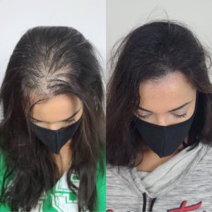 scalp micropigmentation for women houston texas scalp microblading houston tx female hairloss