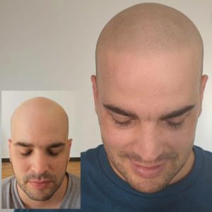 before and after soft hairline bravi smp results