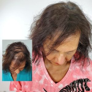 scalp micropigmentation thinning hair austin texas for women female hairloss