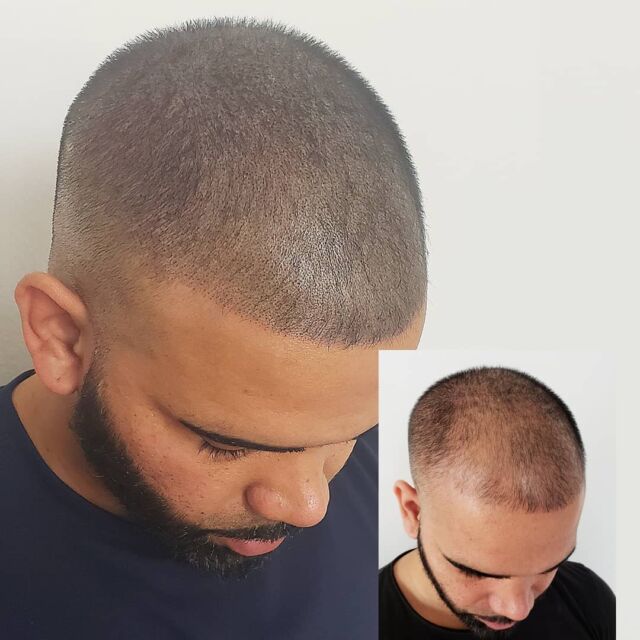 Scalp Micropigmentation In Austin 1 Hair Loss Solution Scalpp Clinic